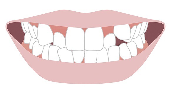 ガチャ歯・ガタガタの歯並びに悩んでいる方へ